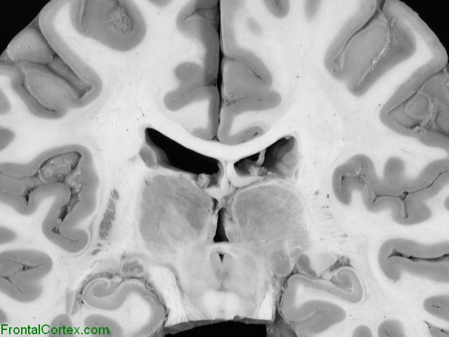 Posterior Commissure Coronal